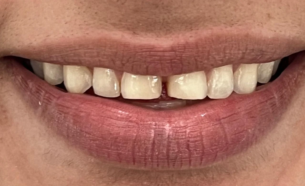 Resultado estético dental