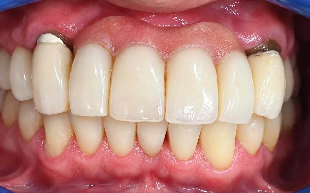 Resultado estético dental