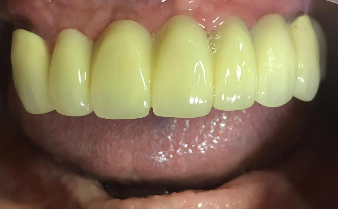 Resultado estético dental